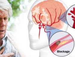 Hati-hati, Minuman Ini Tingkatkan Risiko Stroke Hingga 35 Persen